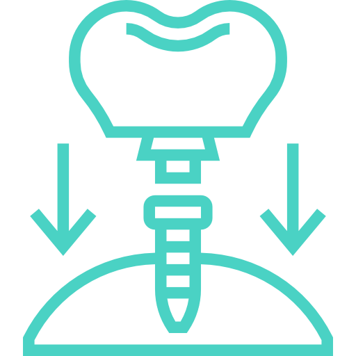 Implantes Dentários